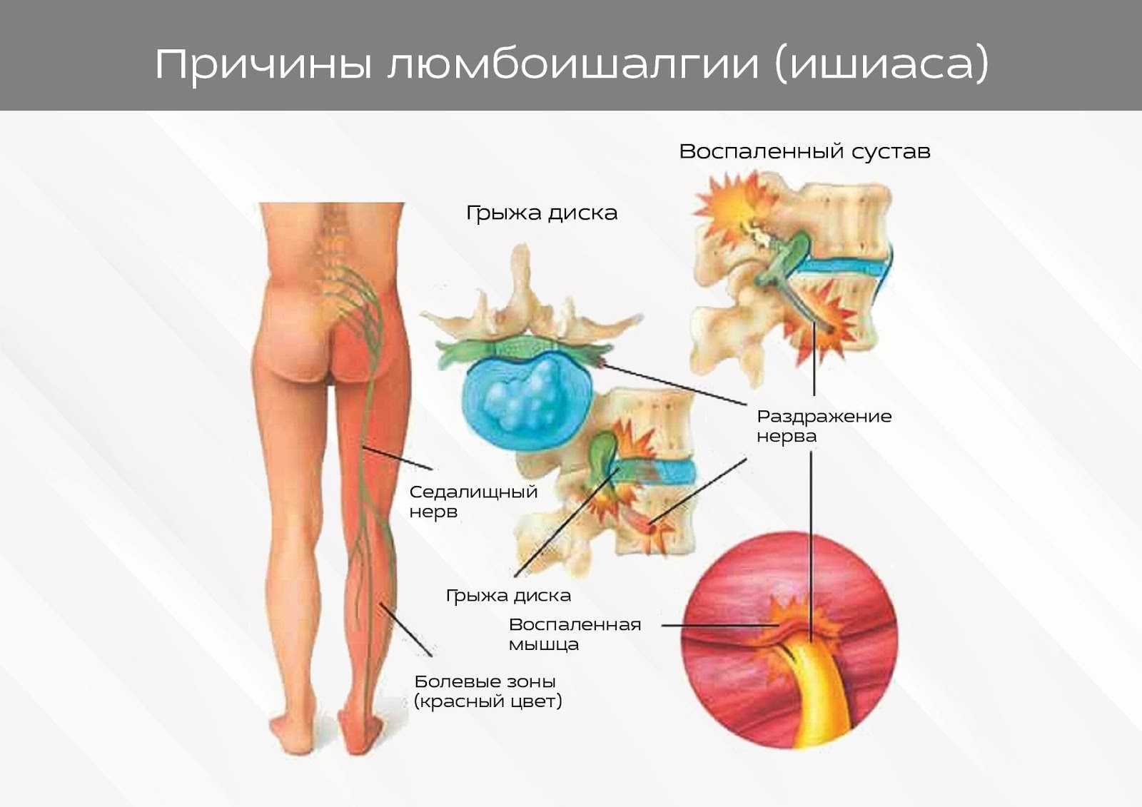 Схема лечения ишиаса медикаментозно