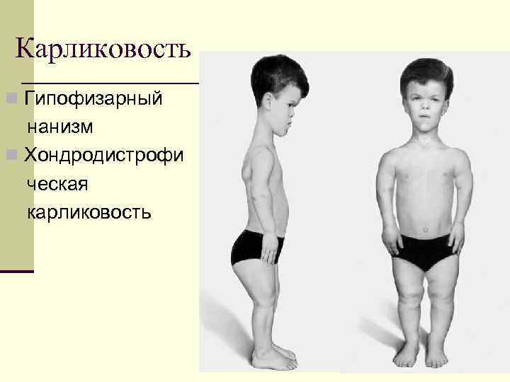 Гипофизарный нанизм: причины, симптомы, диагностика и лечение
