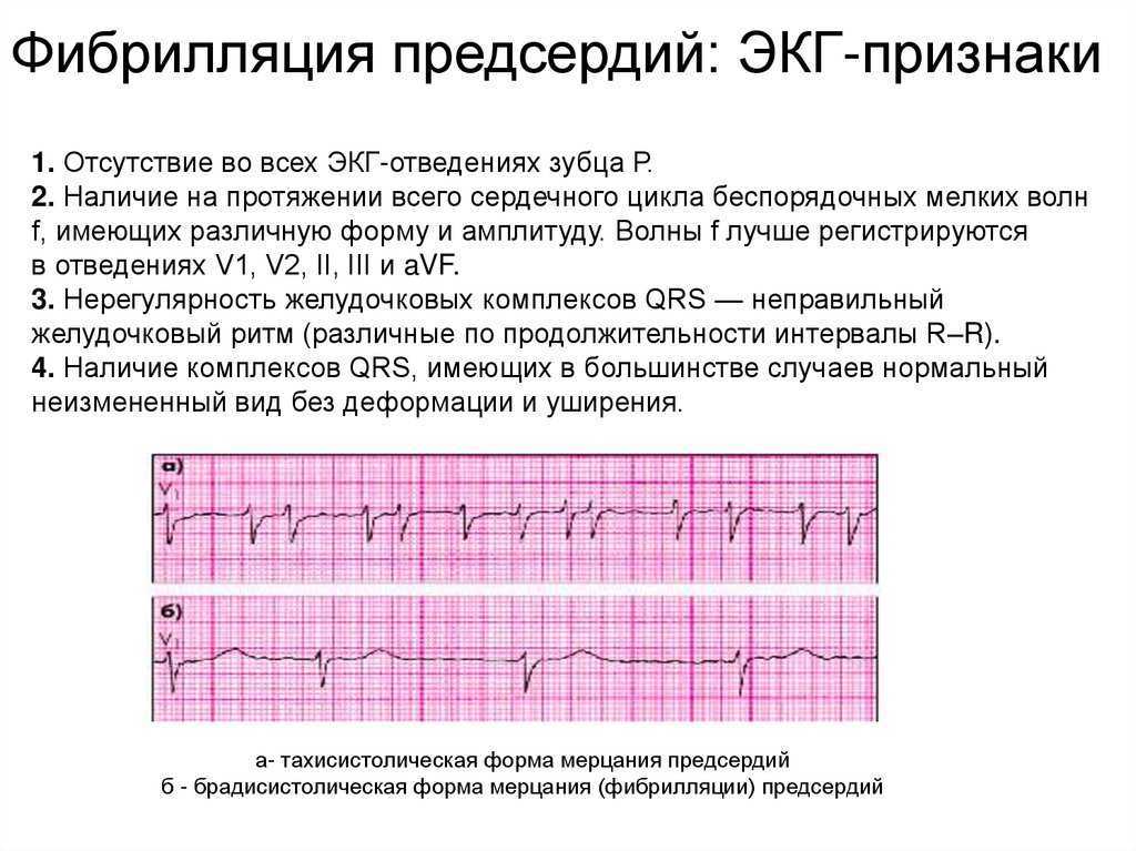 Учащенное сердцебиение - причины, симптомы, методы лечения