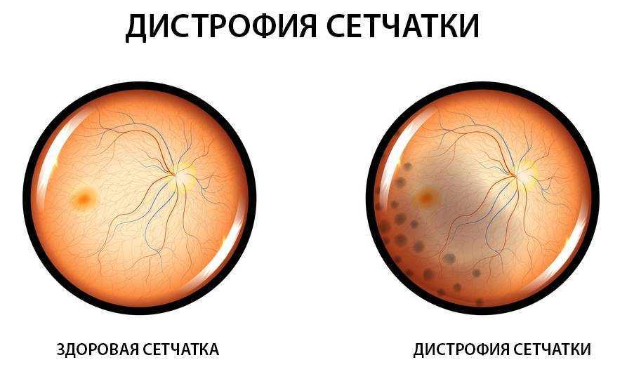 Скотома глаза (темные пятна), причины их возникновения и лечение