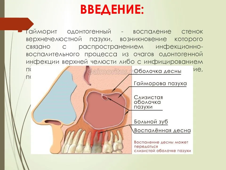 Симптомы и лечение гайморита у взрослых, первые признаки и как проявляется гайморит