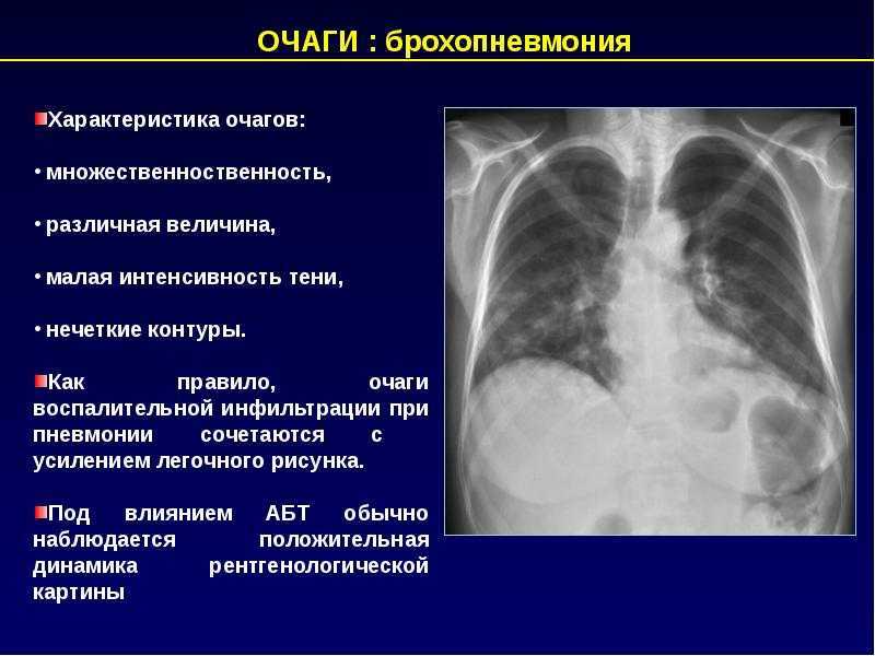 Периваскулярные изменения легочного рисунка у ребенка на рентгене