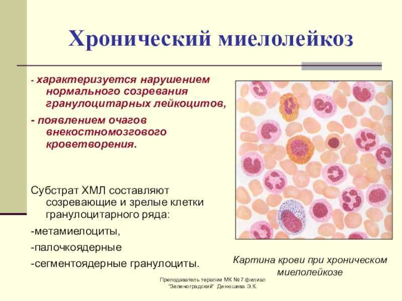 Лейкоз картина крови