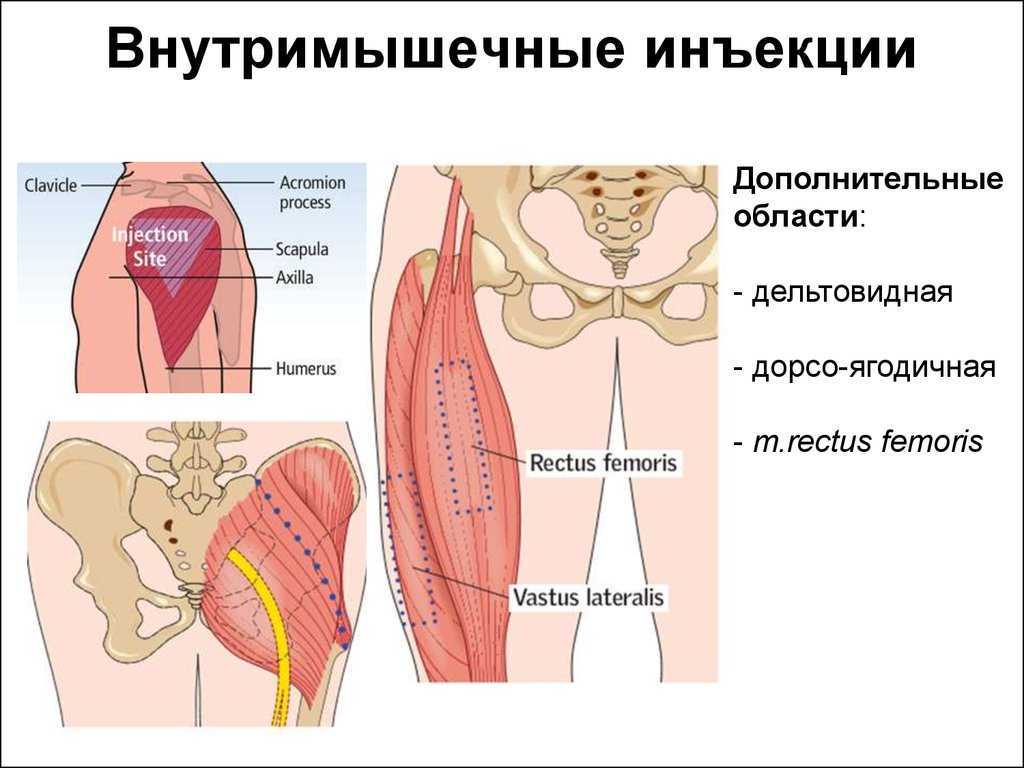 Отметьте на рисунке и напишите места для внутримышечных инъекций