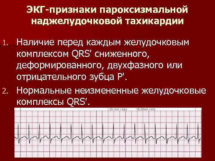 Симптомы тахикардии