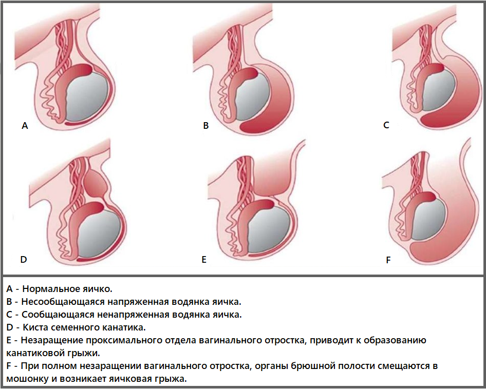 Водянка яичка у мужчин картинки