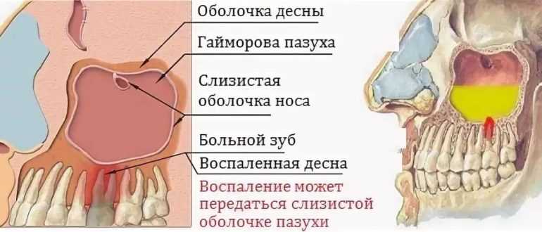 Лечение гайморита