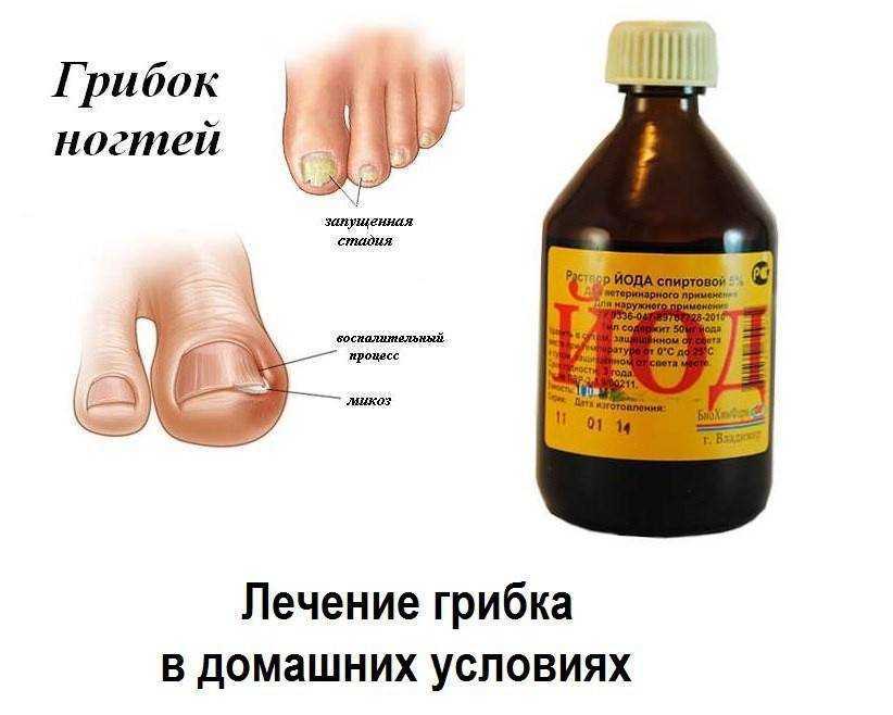 Микоз ногтей - симптомы, диагностика, лечение