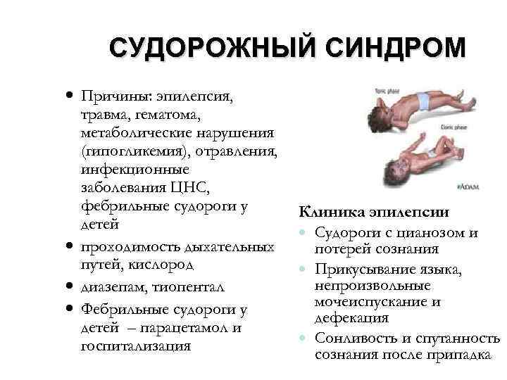 Эпилепсия: причины, симптомы, диагностика, лечение