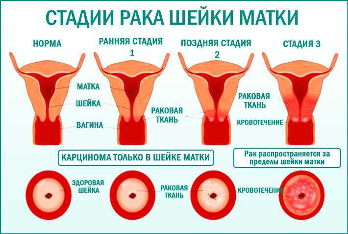 Рак матки картинки