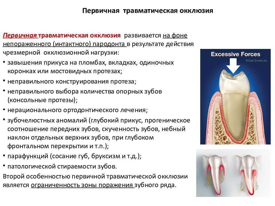 Ортопедические методы лечения генерализованного пародонтита презентация