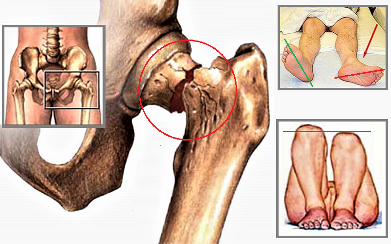 Как определить некроз головки бедра? ortoped-klinik.com