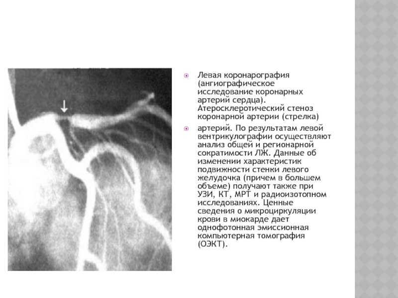 Коронарография сердца через руку