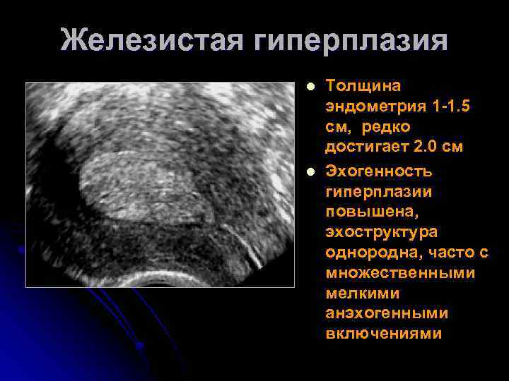 Эндометрий расширен. Гиперплазия эндометрия матки на УЗИ. Гиперплазия эндометрия на УЗИ. Гиперплазия эндометрия УЗИ картина.