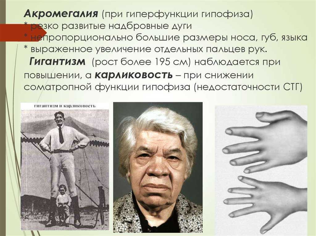 Акромегалия клиническая картина