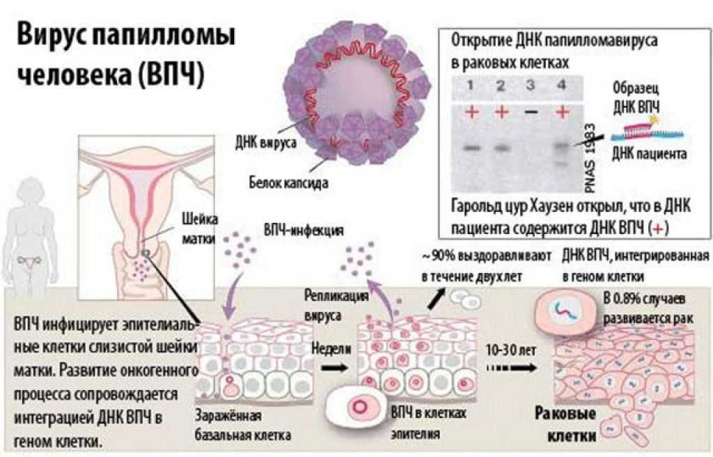 Онкогенный вирус папилломы. ЗППП остроконечные кондиломы. Симптомы вируса папилломы человека 16 типа у мужчин. Папилломавирус онкогенные типы.