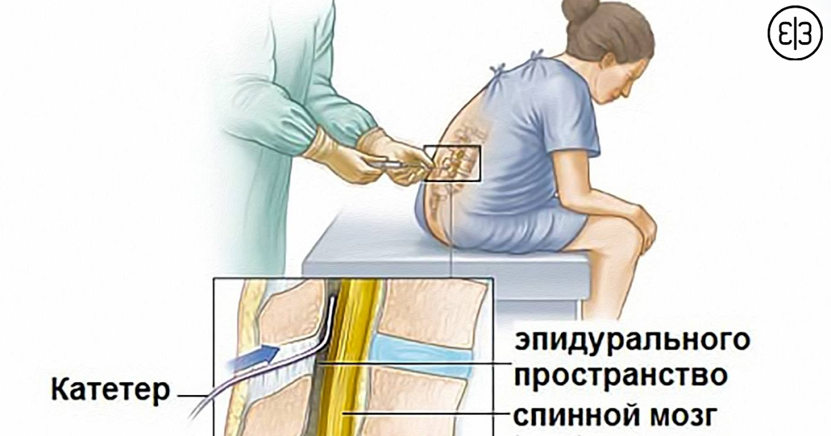 Эпидуральная анестезия картинки