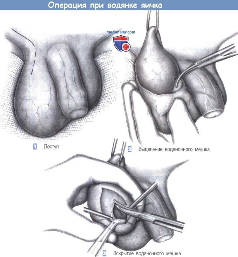 Паховая грыжа водянка оболочек яичка у детей презентация