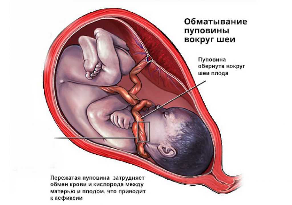 Кесарево когда можно беременеть. Обвитие пуповиной во круг Шем. Однократное обвитие пуповины вокруг шеи плода.