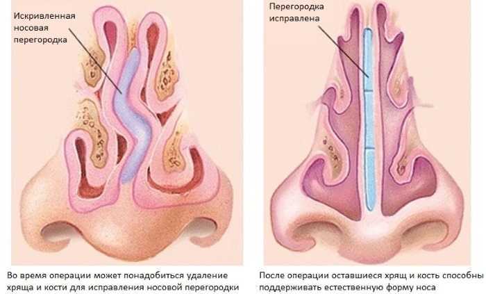 Искривление носовой перегородки - симптомы, современные методы диагностики и лечения | госпитальный центр семейный доктор