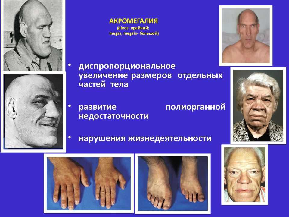 Акромегалия клиническая картина