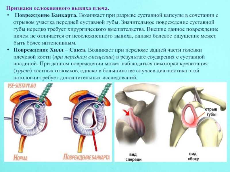 Восстановление после вывиха: как облегчить боль и уменьшить воспаление