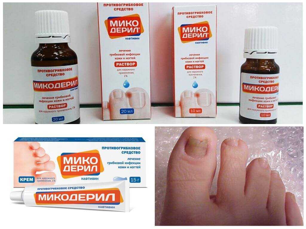 Грибок на ногах (грибок стопы)