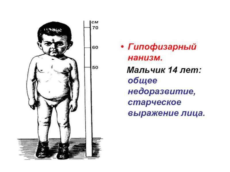 Заболеванию подвержены как мужчины, так и женщины и при карликовом нанизме мужчины достигают роста до 130 сантиметров в то время как рост женщины составляет не более 120 см