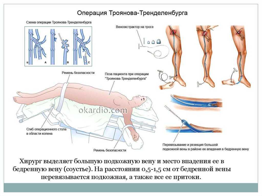 Варикоцеле у мужчин лечение и симптомы | болезнь варикоцеле яичка | операция - центр эндоваскулярной хирургии