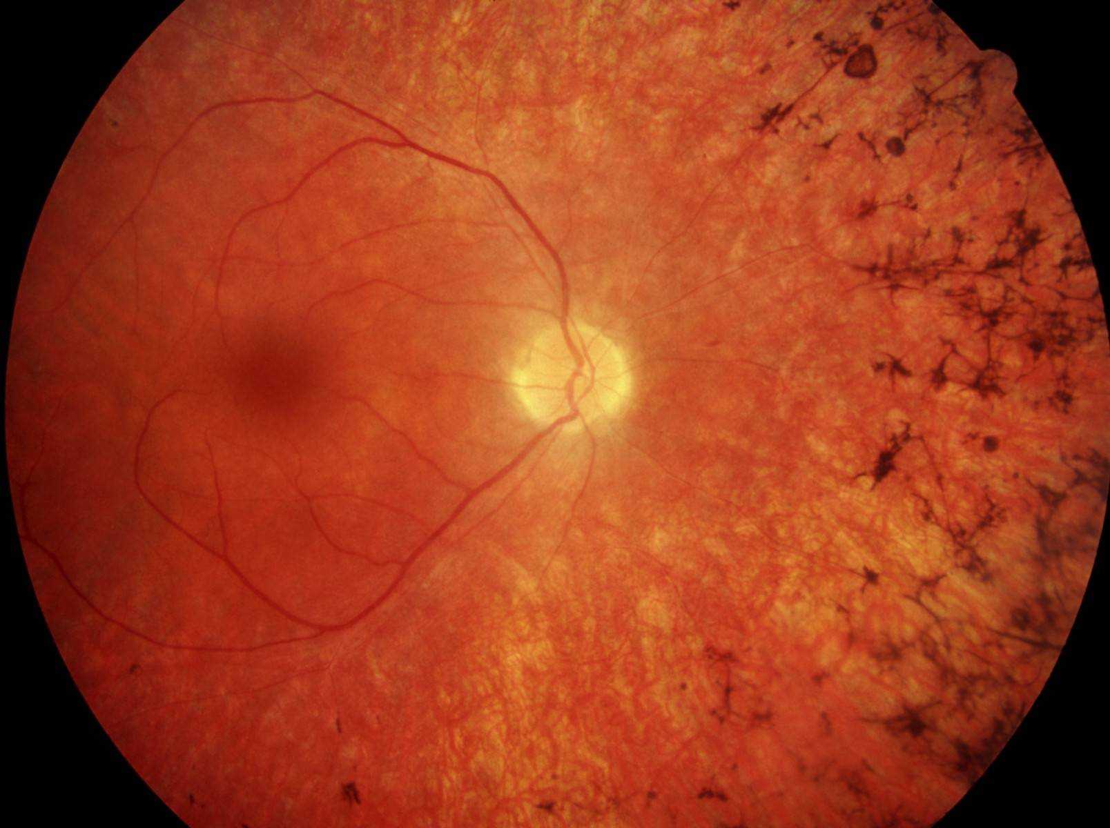 Слепое пятно глаза: строение, функции, что такое слепая зона и как ее найти, тесты, диагностика, симптомы отклонений
