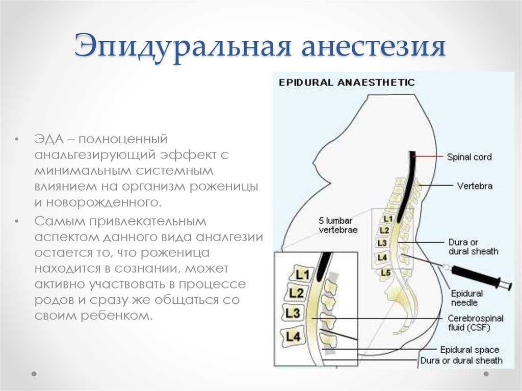 Эпидуральная анестезия картинки