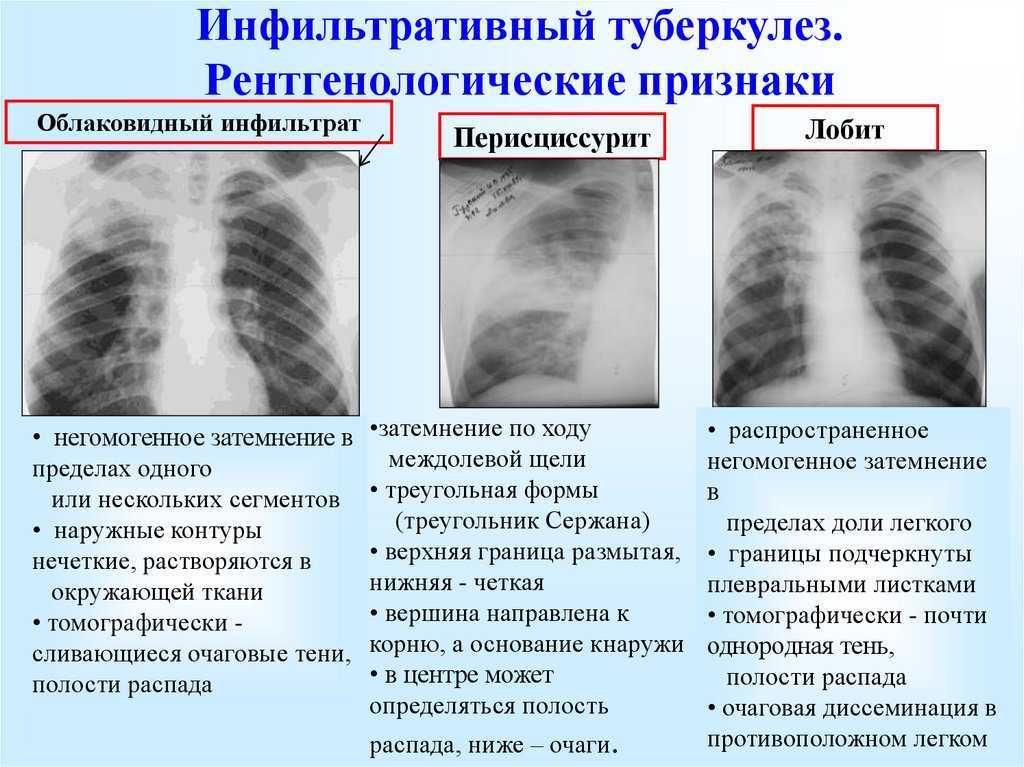 Ампутация корней легких при рентгенологической картине характерна для