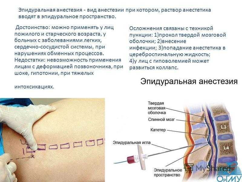 Эпидуральная анестезия картинки