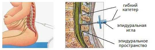 Эпидуральная анестезия картинки