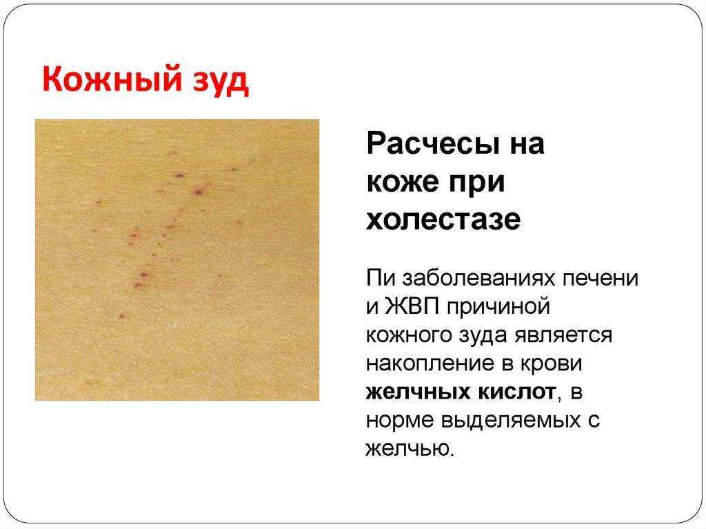 ᐈ первые признаки цирроза печени ~【стадии и диагностика】