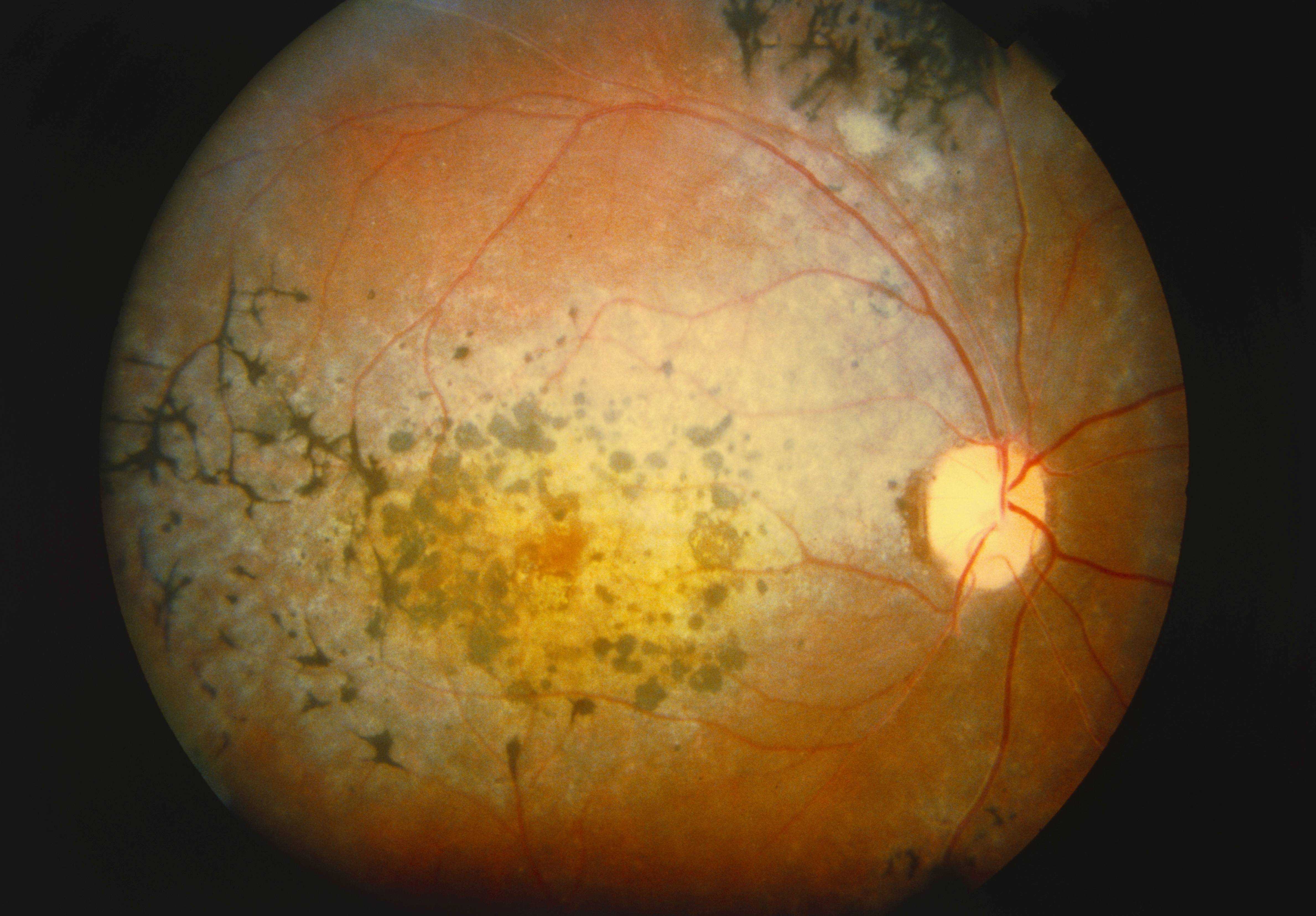 Сетчатка беременности. Тапеторетинальная абиотрофия сетчатки. Пигментный ретинит сетчатки. Пигментная абиотрофия сетчатки.