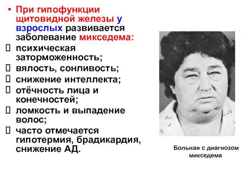 Гипотиреоз - снижение функции щитовидной железы