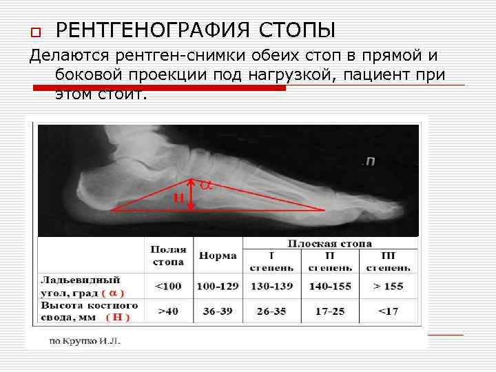 Плоскостопие у взрослых: степени, лечение, профилактика, причины. всё о стопе