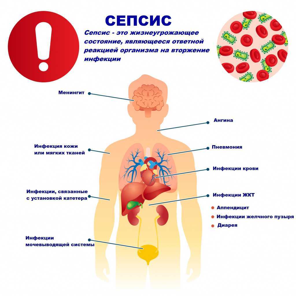 Сепсис