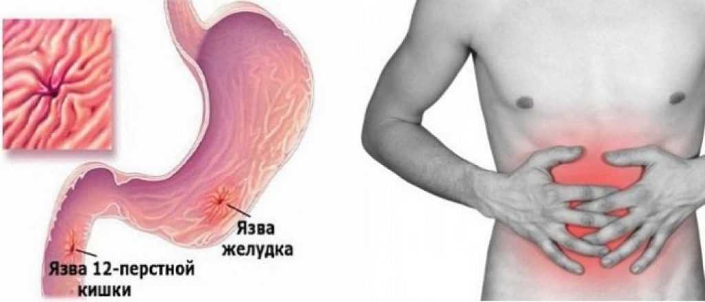 Язва двенадцатиперстной кишки: признаки, симптомы, лечение - медком