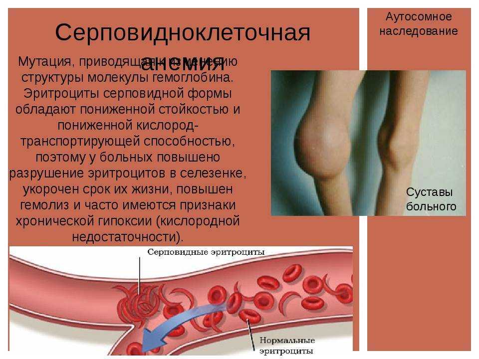 Анемия (низкий гемоглобин) у детей и взрослых - симптомы, степени, причины и лечение - docdoc.ru
