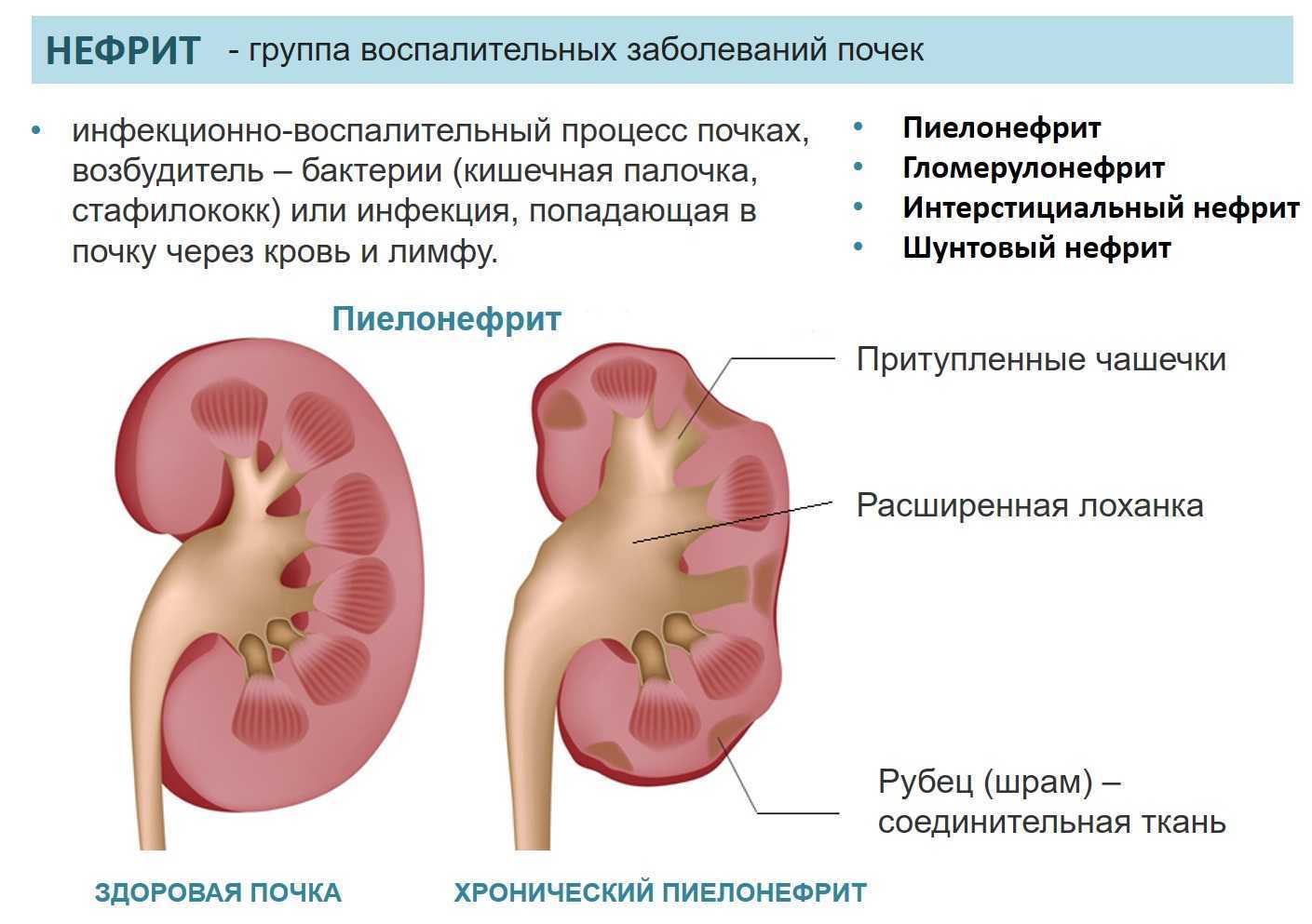 Болезни почек картинки