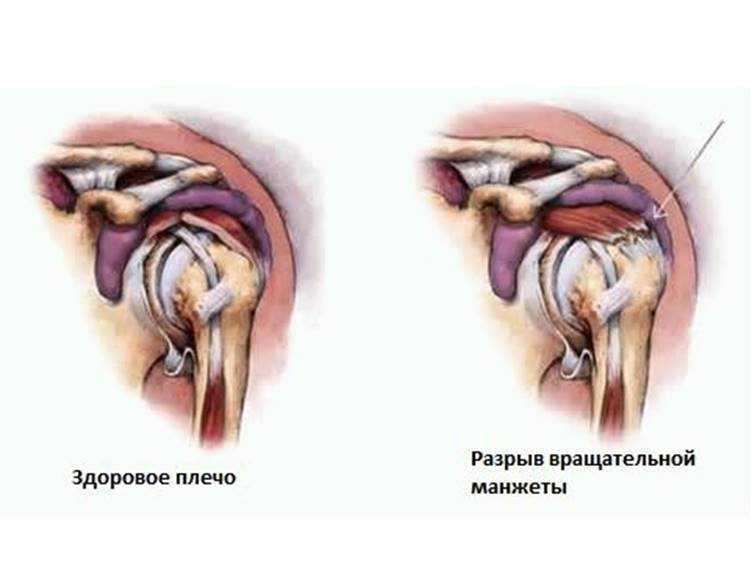 Операция разрыва сухожилия надостной мышцы. Ротаторная манжета плечевого сустава. Мышцы ротаторной манжеты плечевого сустава. Ротаторная манжета плечевого сустава анатомия. Повреждения плеча вращательной манжеты s46.