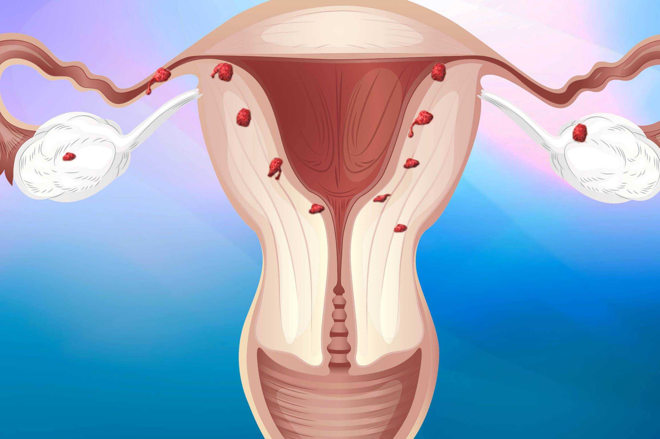 Чем лечить эндометриоз матки у женщин. Альгодисменорея аденомиоз. Эндометриоз гинекология.