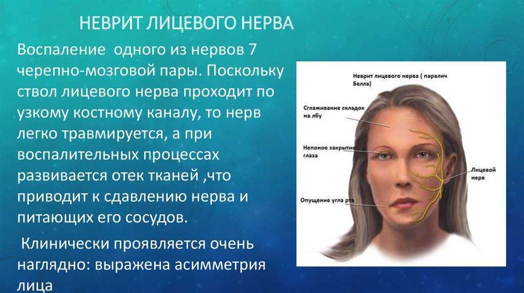 Синдром марфана: причины, симптомы, диагностика и лечение заболевания