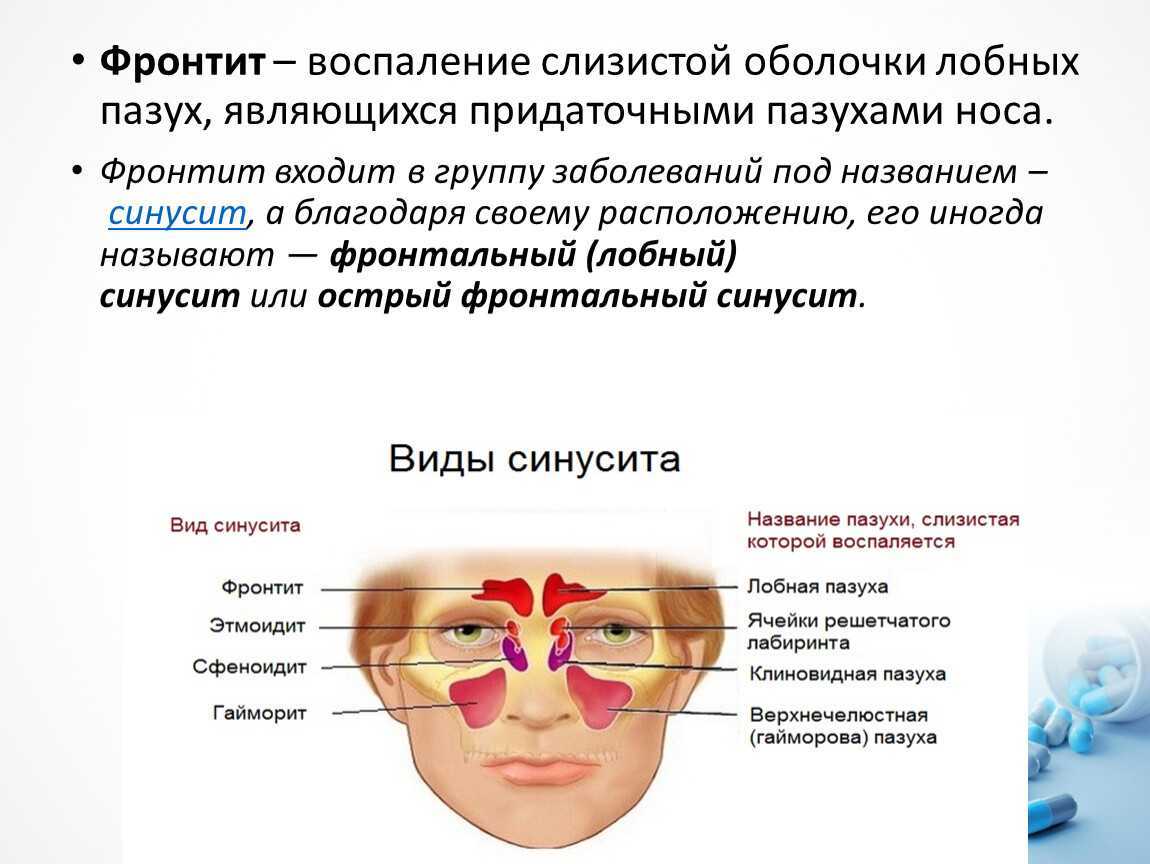 Фронтит схема лечения