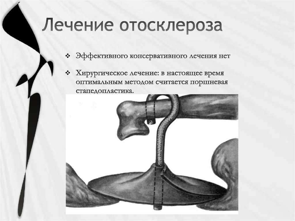 Отосклероз