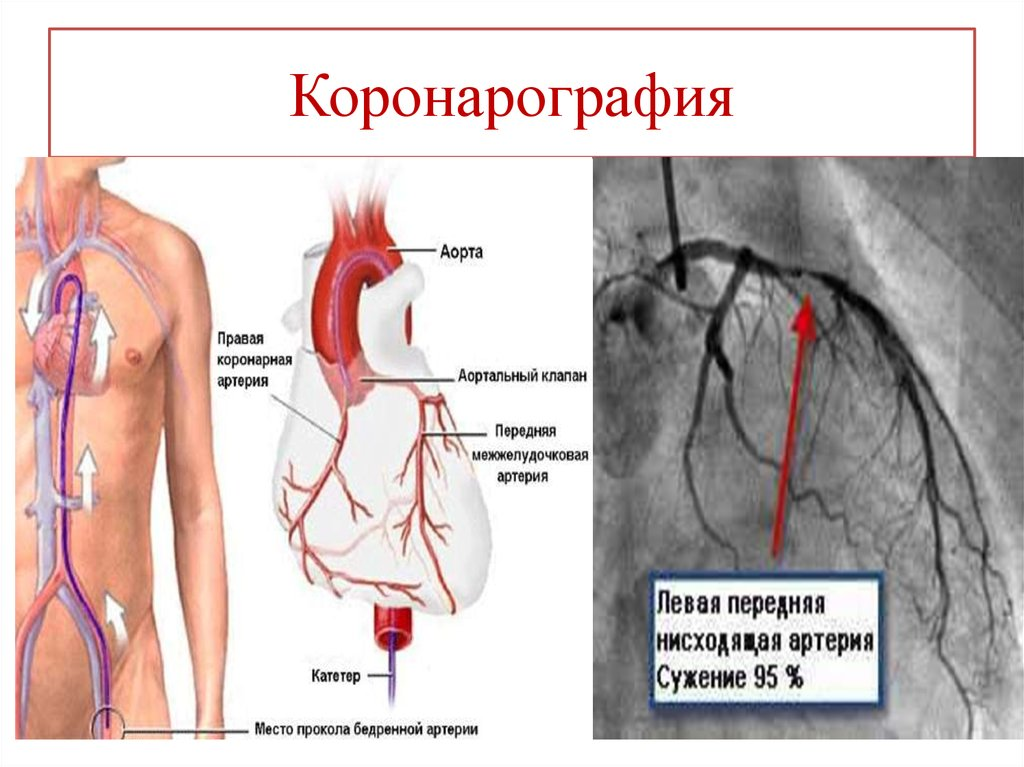 Коронарография: показания к проведению, виды исследования