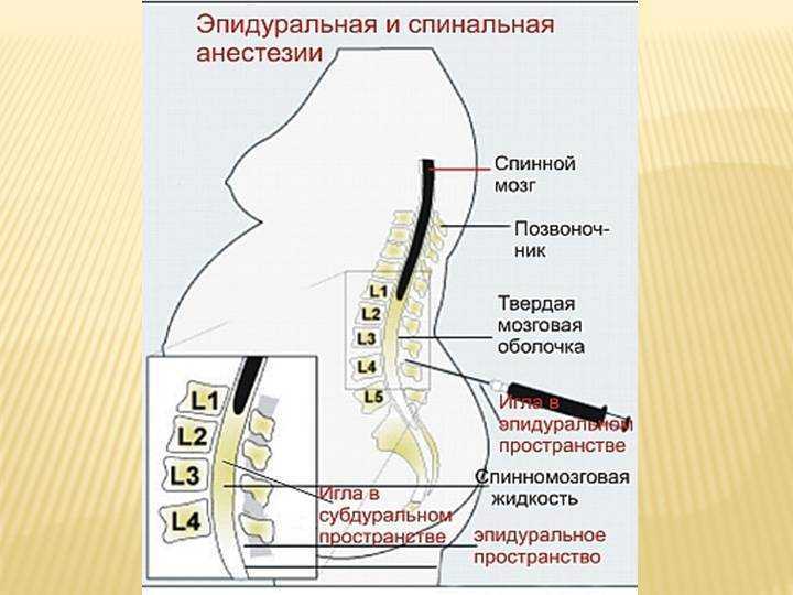 Эпидуральная анестезия