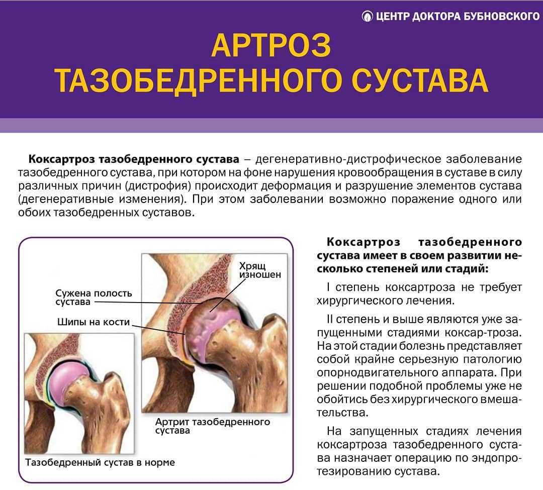 Артрит прием. Деформирующий остеоартроз тазобедренного сустава II степени. Заболевание артроз тазобедренного сустава. Артрит артроз тазобедренного сустава.